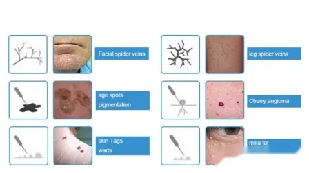 Vein Removal Spider Rbs Aesthetic Equipment Vascular Removal Portable High Frequency Facial Machines 
