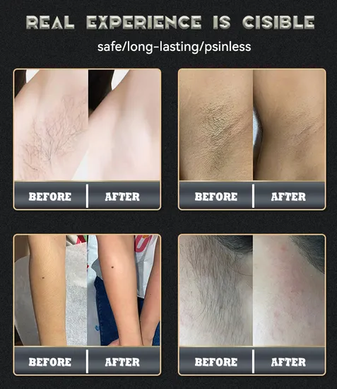 FDA TUV CE Approved Professional Ice Titanium Laser 755 808 940 1064 Laser Hair Removal 600